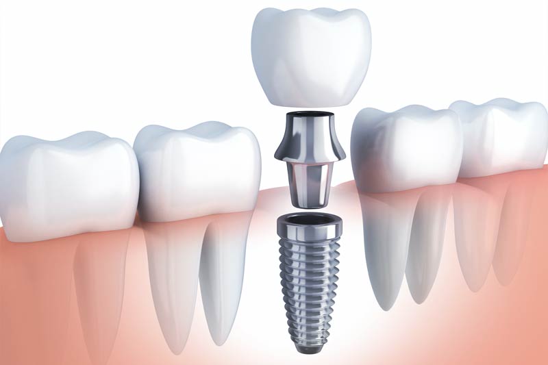 Implants Dentist in Cleburne