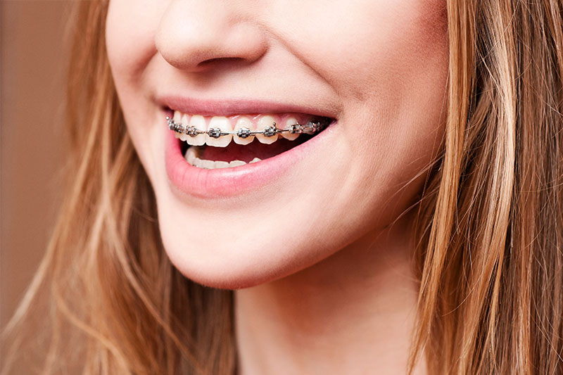 Orthodontics in Cleburne