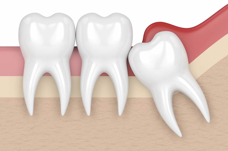 Wisdom Tooth Removal in Cleburne